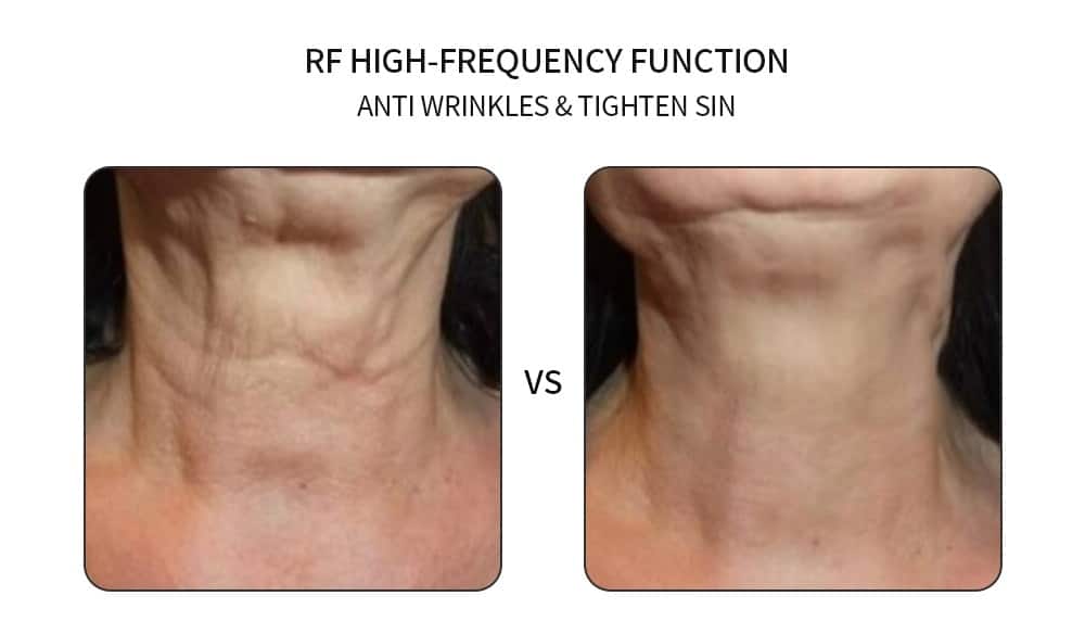 mesotherapy electroporation rf skin rejuvenation device led light therapy 5